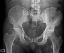 Paget Disease Of The Bone Radiology Case Radiopaedia Org Pagets Disease Radiology Paget