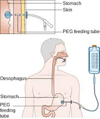 What Is A Feeding Tube Types Complications Study Com