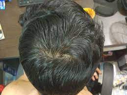 However, the top hairstyles for black men seem to incorporate a low, mid or high fade haircut … getting and styling the best afro hairstyles for men shouldn't be a tedious search. Seems To Be Sudden Thinning Of Hair On Top Of Head Always Had Thin Hair Didn T Pay Attention Earlier Mpb Or Te Photo