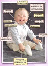 Characteristics Down Syndrome Kids Down Syndrome Trisomy 21
