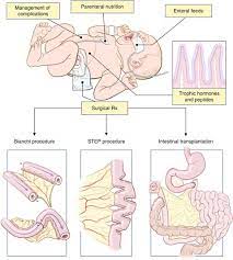 Short Bowel Syndrome In Children Springerlink