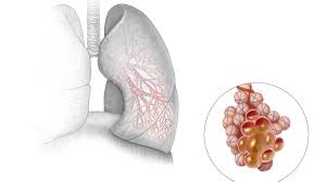 Noen slim i lungene er normalt og nødvendig for en sunn brystet og holde smuss og andre uønskede partikler fra å komme inn i lungene. Lungebetennelse Pneumoni Lhl