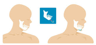 Genioplasty Chin Surgery Types Complications And Outlook
