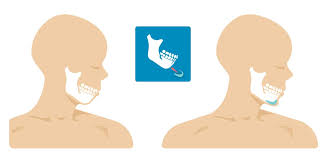 genioplasty chin surgery types complications and outlook