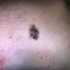 Lentigo malign melanom, yüzeyel yayılan malign melanom, akral lentiginöz. Malignes Melanom Doccheck Flexikon
