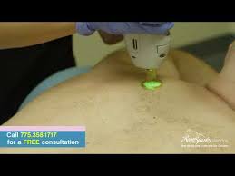 6.3 hair removal instrument armpit pubic hair. Laser Hair Removal For Men Reno Nv Laser Hair Removal For Women Reno Nv