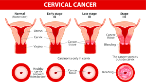 Unlike many other cancers whose causes are largely still unknown, cervical cancer is most often caused by human papillomavirus (hpv). Cervical Cancer Symptoms And Causes I Fashion Styles