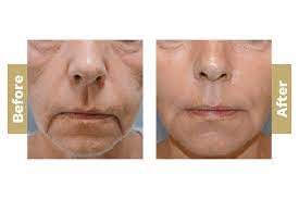 The reason lemon juice is an amazing way to help you get rid of the marionette lines is because of the acid in it. Marionette Lines Dermalogic Aesthetics
