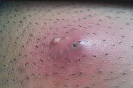 Ingrown hair occurs when instead of growing to the surface the hair starts growing back into the skin. Ingrown Hair Cyst