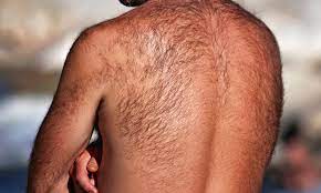 Die Haartransplantation Mit Ruckenhaaren Tophairclinic