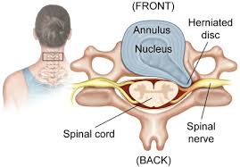 Jaw joint has a disc that can get damaged & slip. A Case Study For Massage Therapists Distinguishing Myofascial Neck Pain From Herniated Disk Pain The Well Bodymindheartspirit
