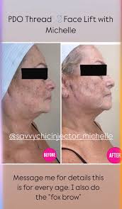✨ PDO Thread Face Lift with Michelle ✨ Ready to lift, contour, and glow?  See the real results from this non-surgical facelift—perfect for all ages!  💉 9 Years PDO Experience: ✔️ Full