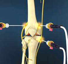 Image result for Radiofrequency Surgery