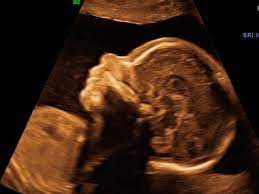 Megauretern bei der feindiagnostik und der arzt fragte nur, ob ich den ein bild vom gesicht des zwergis hätte.und da wurde halt mehr durch zufall festgestellt. Organscreening Wird Der Zweite Ultraschall Jetzt Noch Genauer Eltern De