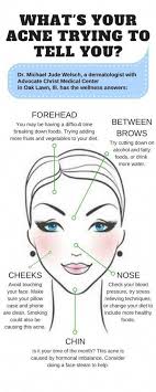 What S Your Acne Trying To Tell You Health Enews Face Mapping Acne Face Acne Face Mapping