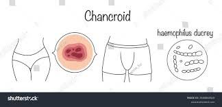 Image result for chancroid