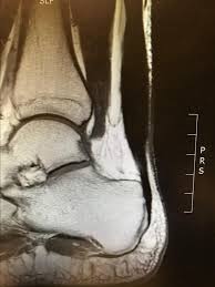 Achilles Tendonitis Article