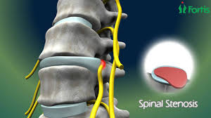 A slipped disc is when a soft cushion of tissue between the bones in your spine pushes out. Micro Lumbar Discectomy Fusion Spine Surgery Neuro Surgery Fortis Healthcare India Youtube