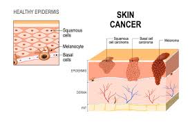 Thank you, {{form.email}}, for signing up. Symptoms Of Skin Cancer Archives Care Cover