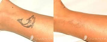 (smarter every day) laser tattoo removal might look simpler than getting inked, but it's actually a really complicated process that shouldn't be relied on as a casual solution to a permanent problem. Life Death And Laser Tattoo Removal In Dallas