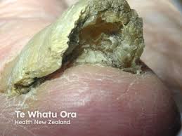 Image result for Onychogryphosis feet