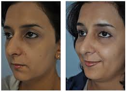 How to contour a wide nose to look smaller and pointy. Ethnic Rhinoplasty Los Angeles Custom Ethnic Nose Job