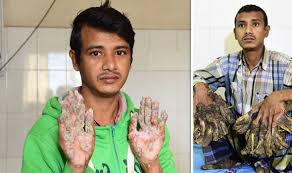 Tree man is a genetic disorder in which strange warts appear all over body. Tree Man Online Schauen Auf Mit Untertiteln 720p Heretfiles