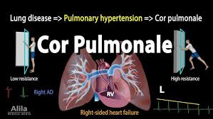 Image result for Cor Pulmonale