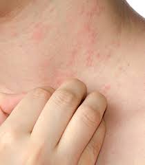 Palmoplantar pustulosis (ppp) is a type of pustular psoriasis that forms on the palms of your hands (usually at the base of your thumb), as well as on the soles of your feet and the sides of your. Decomed