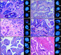 Scientists are testing to see whether their incredible sense of smell can lead to early identification of cancers. Prostate Cancer With Paneth Cell Like Neuroendocrine Differentiation Download Scientific Diagram