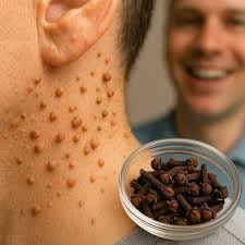 Homemade clove oil remedy for skin and pain