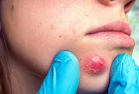 Before developing into a typical cyst, an infected ingrown hair normally begins as a small or big pimple. Is Pus A Sign Of Infection What Causes It