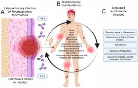 Image result for Extrapulmonary Tuberculosis