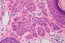 Of course, your specialist is the main person whose advice you should follow but it doesn't do anyone harm. Squamous Cell Skin Cancer Wikipedia