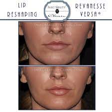 May 17, 2018 · volbella is the fourth product. Revanesse Versa Before And After Injectability Clinic Revanesse Dermal Fillers Filler Before And After