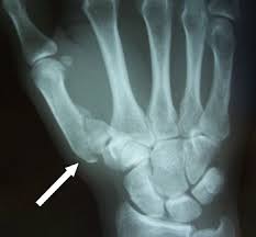 Haufige Fragen Rund Um Die Arthrose Des Daumen Sattelgelenks Rhiz Arthrose Handerkrankungen