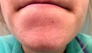 Advise Please I Have These Small White Yellowish Things Coming Out Of My Pores But Only Under My Bottom Lip Rubbing Them Won T Get Them Out Only Tweezing Which Is Time Consuming They
