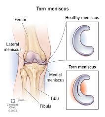 Image result for Thessaly Test