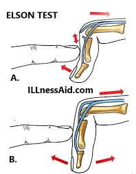 Image result for Elson Extensor Tendon Test