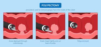 Image result for Colon Cancer Screening with Colonoscopy