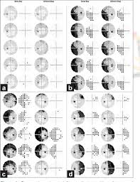 Image result for Visual Field Deficit