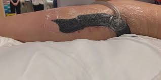 Al Dermatologist Warns Swimmers After Flesh Eating Bacteria Case In Fl