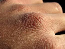The skin between your toes has become really dry, but it's not itchy. Excessively Thick Dry Skin On Feet And Hands Lovetoknow