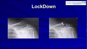 Trace the line under the clavicle towards the svc. Antero Posterior Position Of The Lateral Clavicle Following Ac Joint Reconstruction Youtube