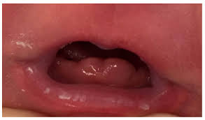 Image result for Neonatal Teeth