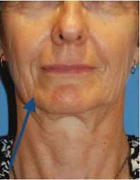 They are called marionette lines as they resemble the lines that run on the face of a marionette. Marionette Lines Treatment With Facelift Dr Philip Young In Seattle