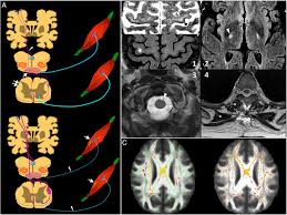 Esta enfermedad también es conocida como la enfermedad de lou gehrig. Neuroimagen Y Ensayos Clinicos Con Celulas Madre En La Esclerosis Lateral Amiotrofica Perspectivas De Presente Y Futuro Sciencedirect