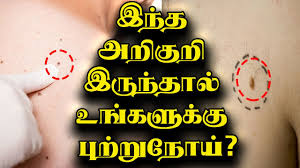 If the cancer was caught early enough, the. Stomach Cancer Symptoms In Tamil Pdf Cancerwalls