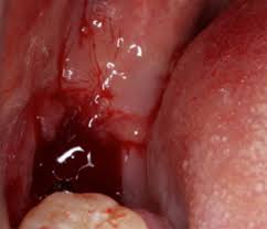 Your tooth extraction will be performed in a medical or dental office or how might a tooth extraction affect my everyday life? A Bleeding Socket After Tooth Extraction The Bmj