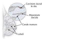 Prin definitie, nu exista niciun risc de recidiva la distanta, deoarece cancerul este neinvaziv. Carcinom Ductal In Situ Cel Mai Frecvent Tip De Cancer Mamar Cancer360